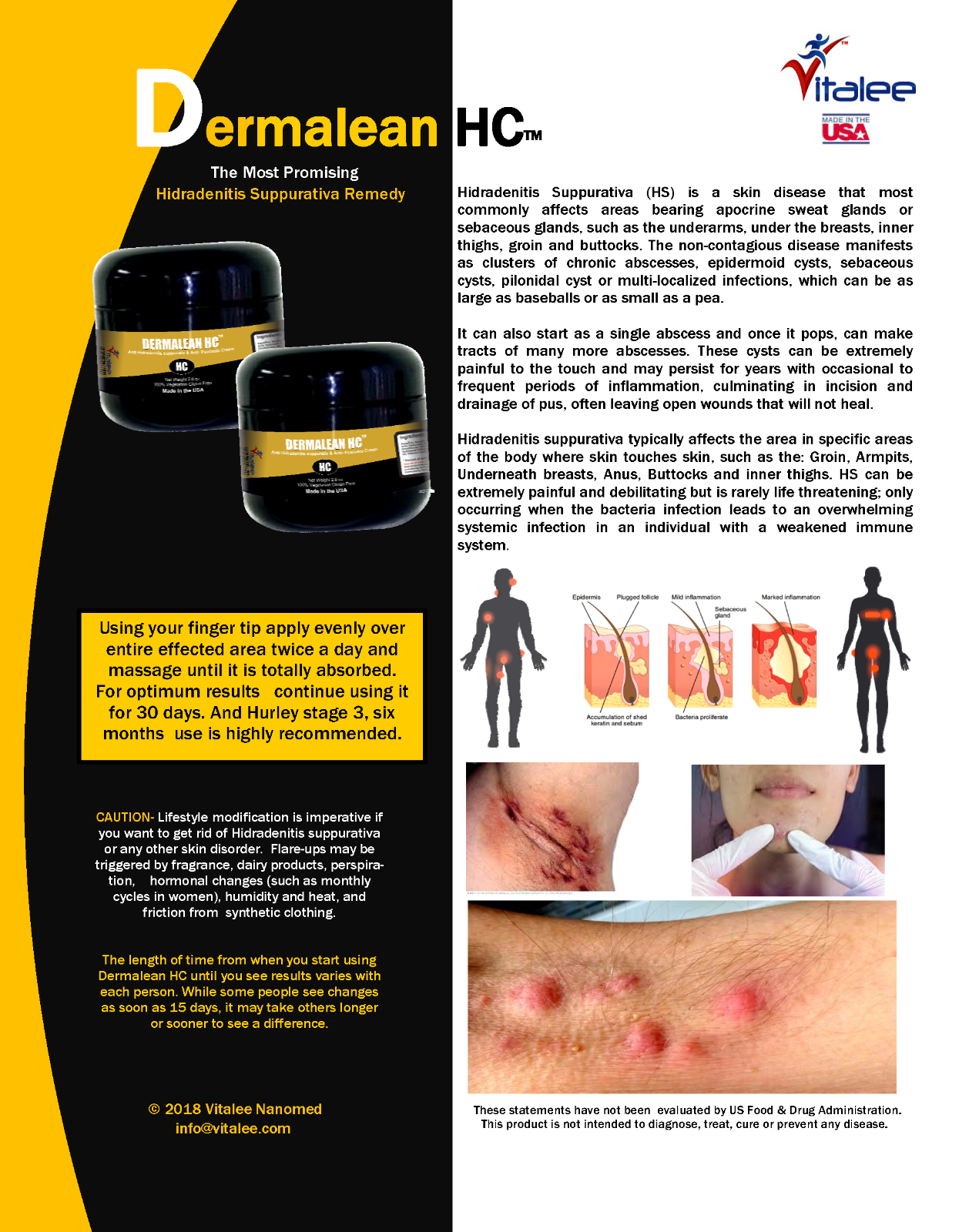 Dermalean HC-Hidradenitis Suppurativa Stage 2 Pack of 3 Bottles (2 Oz Cream)