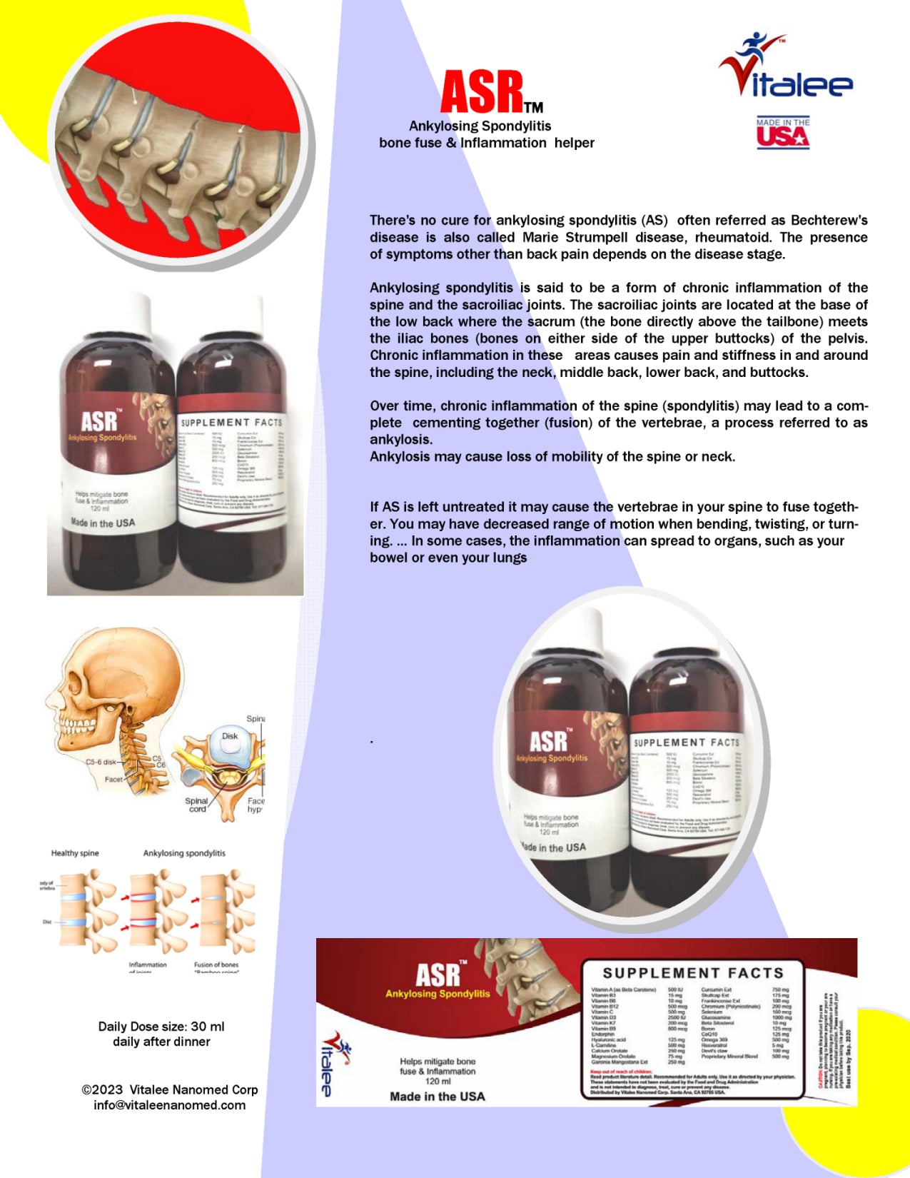 ASR- Ankylosing Spondylitis- Neck Rheumatoid Arthritis